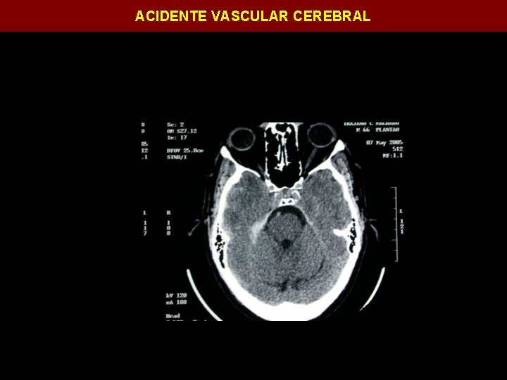 ACIDENTE VASCULAR CEREBRAL 