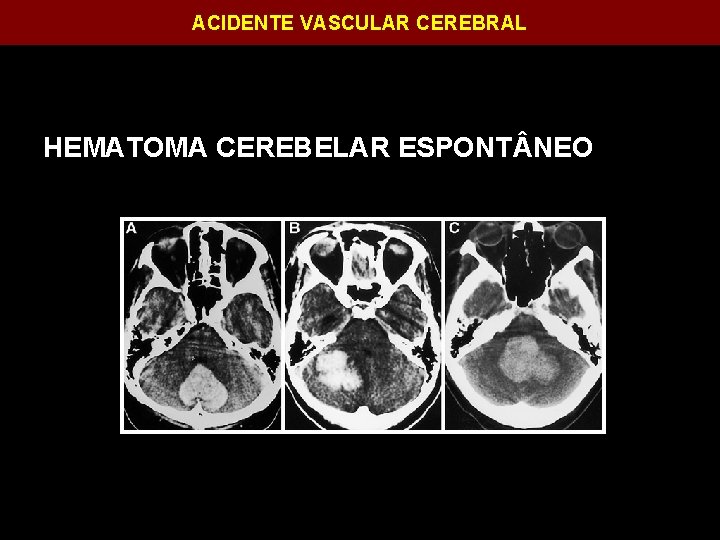 ACIDENTE VASCULAR CEREBRAL HEMATOMA CEREBELAR ESPONT NEO 