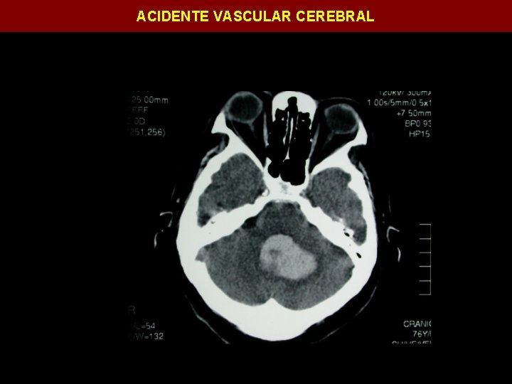 ACIDENTE VASCULAR CEREBRAL 