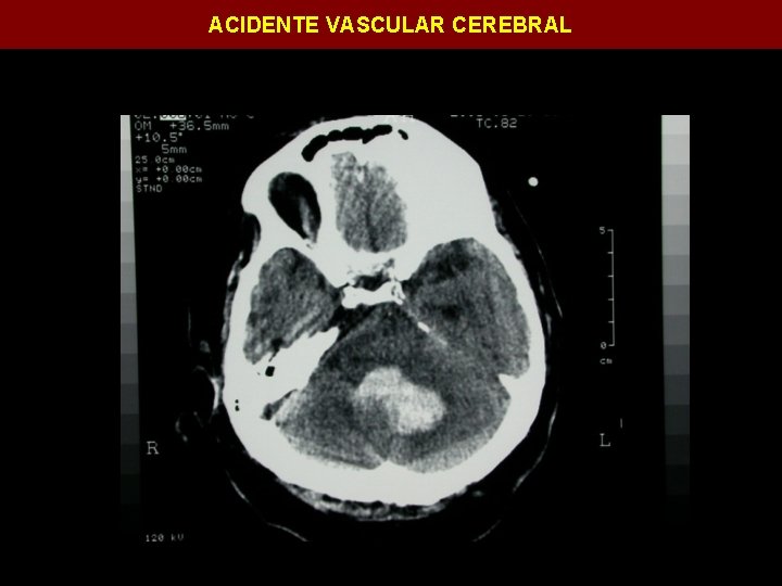 ACIDENTE VASCULAR CEREBRAL 