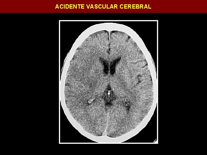 ACIDENTE VASCULAR CEREBRAL 