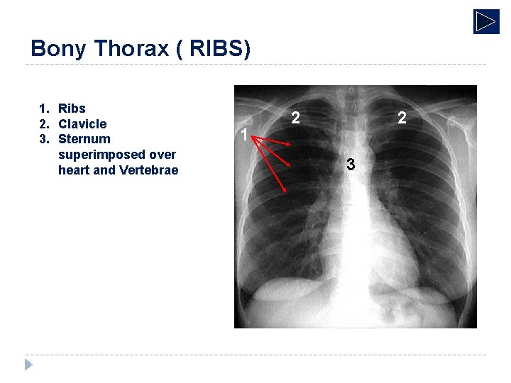 Bony Thorax ( RIBS) 1. Ribs 2. Clavicle 3. Sternum superimposed over heart and