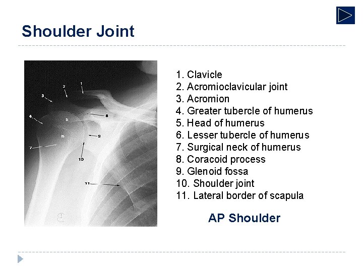 Shoulder Joint 1. Clavicle 2. Acromioclavicular joint 3. Acromion 4. Greater tubercle of humerus