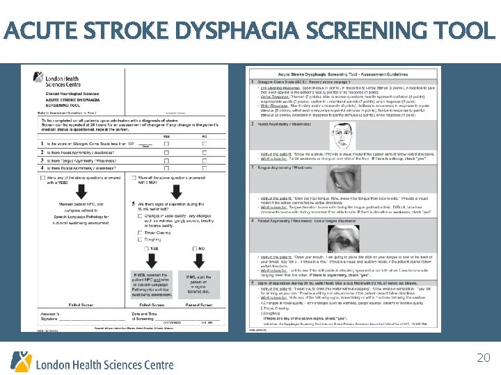 ACUTE STROKE DYSPHAGIA SCREENING TOOL 20 