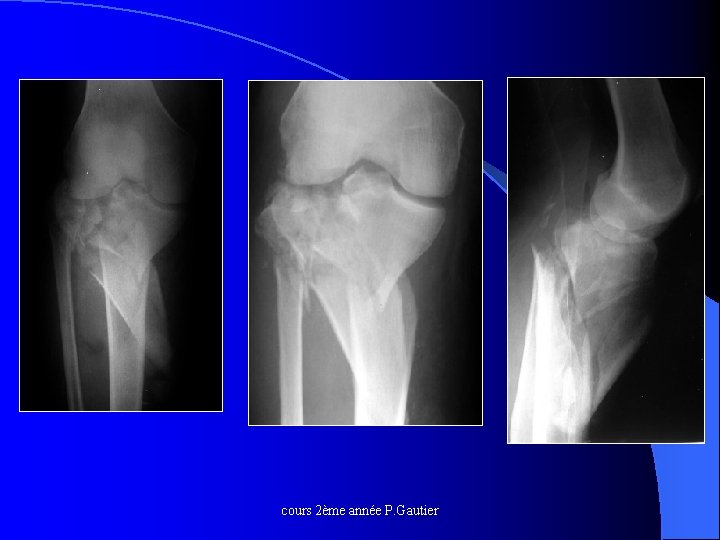 cours 2ème année P. Gautier 