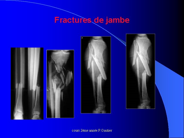  Fractures de jambe o cours 2ème année P. Gautier 