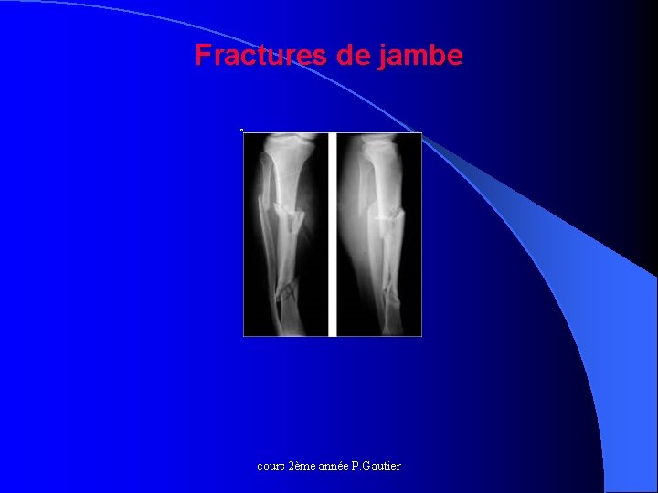 Fractures de jambe o cours 2ème année P. Gautier 