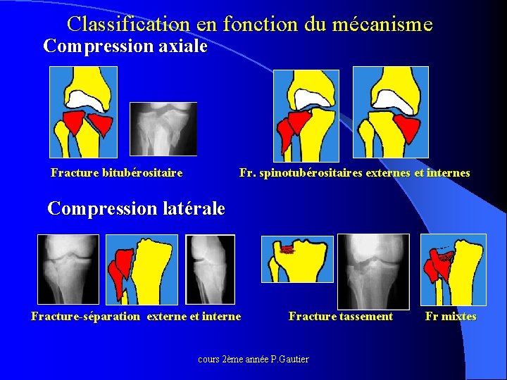 Classification en fonction du mécanisme Compression axiale Fracture bitubérositaire Fr. spinotubérositaires externes et internes