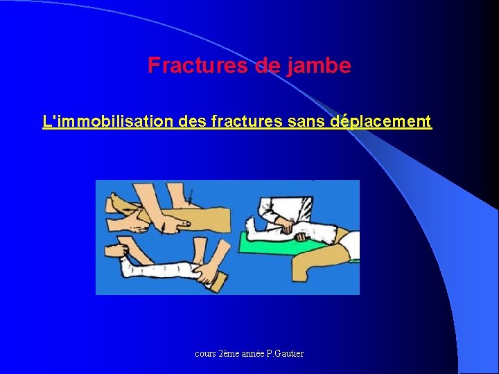 Fractures de jambe L'immobilisation des fractures sans déplacement cours 2ème année P. Gautier 