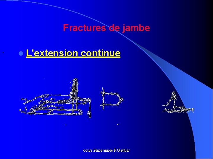 Fractures de jambe. l L'extension continue cours 2ème année P. Gautier 