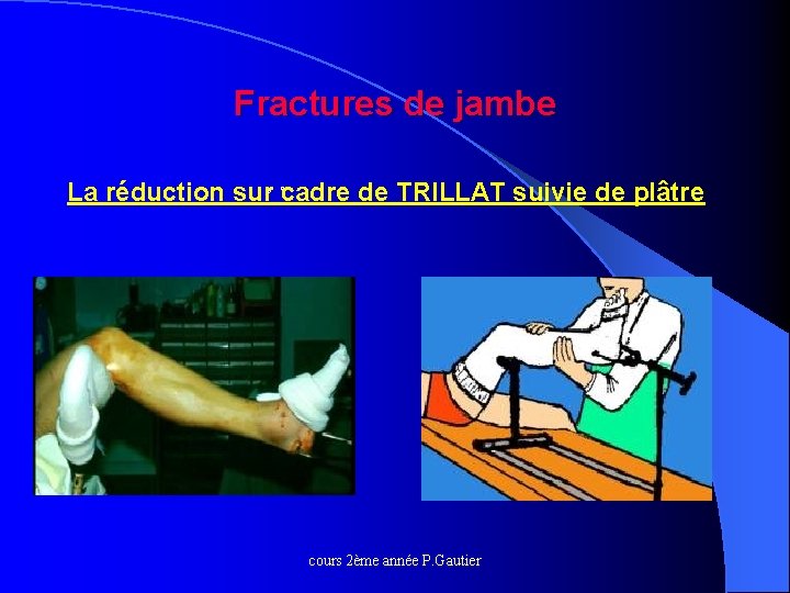 Fractures de jambe La réduction sur cadre de TRILLAT suivie de plâtre o o