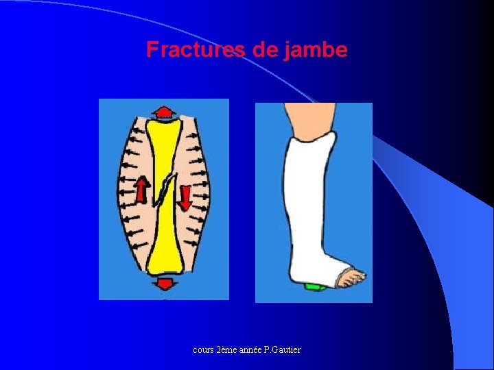 Fractures de jambe cours 2ème année P. Gautier 