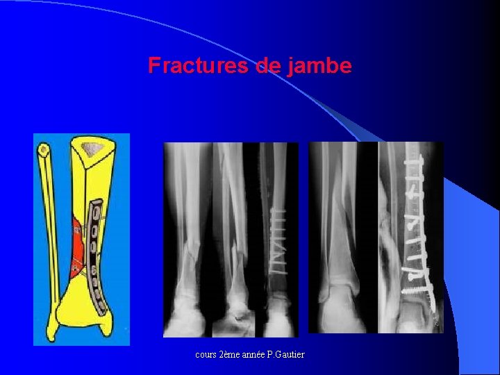 Fractures de jambe cours 2ème année P. Gautier 