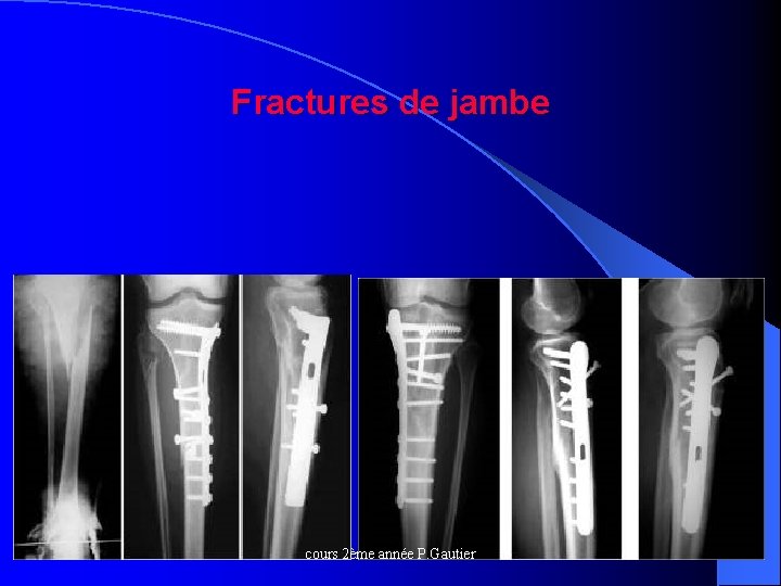 Fractures de jambe cours 2ème année P. Gautier 
