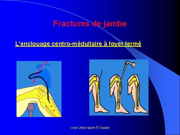 Fractures de jambe L'enclouage centro-médullaire à foyer fermé cours 2ème année P. Gautier 