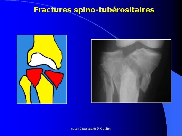 Fractures spino-tubérositaires cours 2ème année P. Gautier 