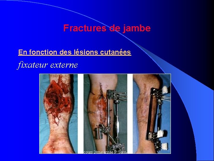 Fractures de jambe En fonction des lésions cutanées fixateur externe cours 2ème année P.