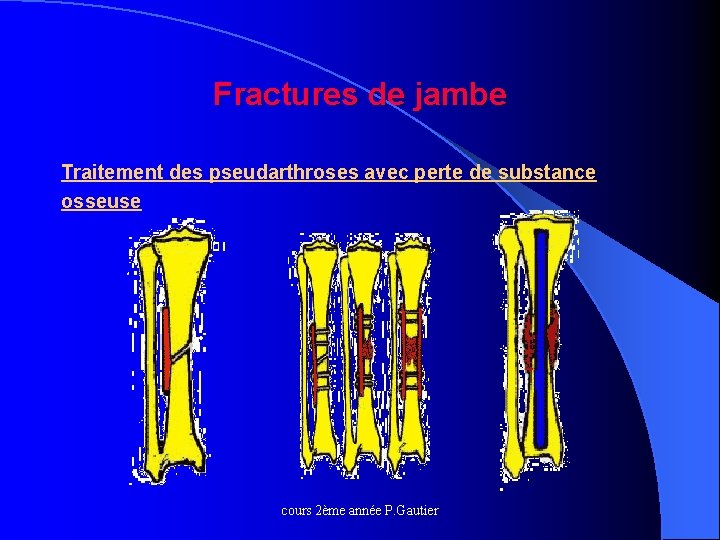 Fractures de jambe Traitement des pseudarthroses avec perte de substance osseuse cours 2ème année