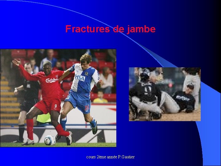 Fractures de jambe cours 2ème année P. Gautier 