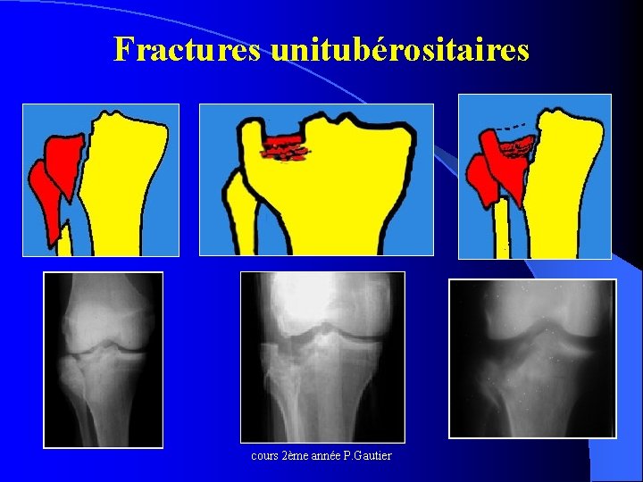 Fractures unitubérositaires cours 2ème année P. Gautier 