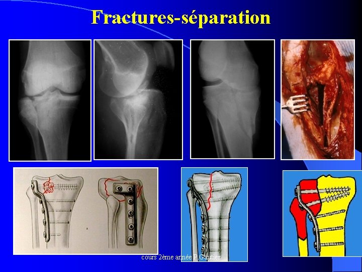 Fractures-séparation cours 2ème année P. Gautier 