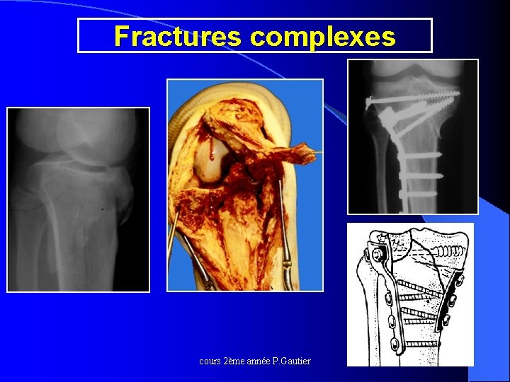 Fractures complexes cours 2ème année P. Gautier 