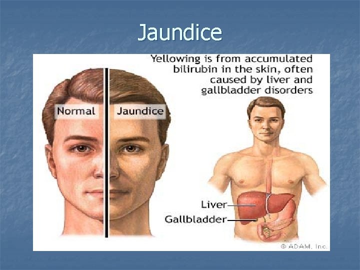 Jaundice 