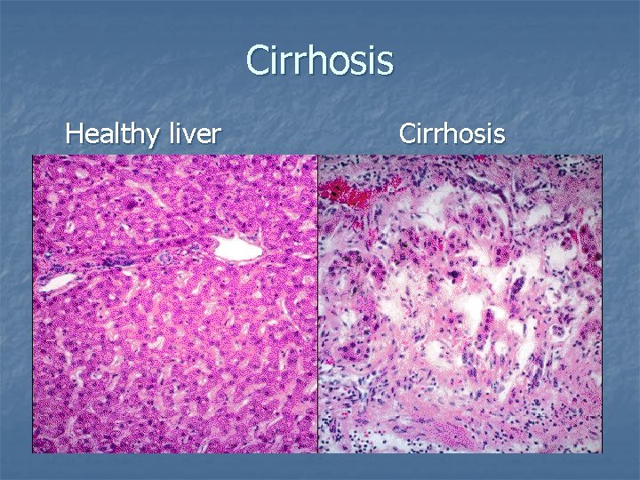 Cirrhosis Healthy liver Cirrhosis 