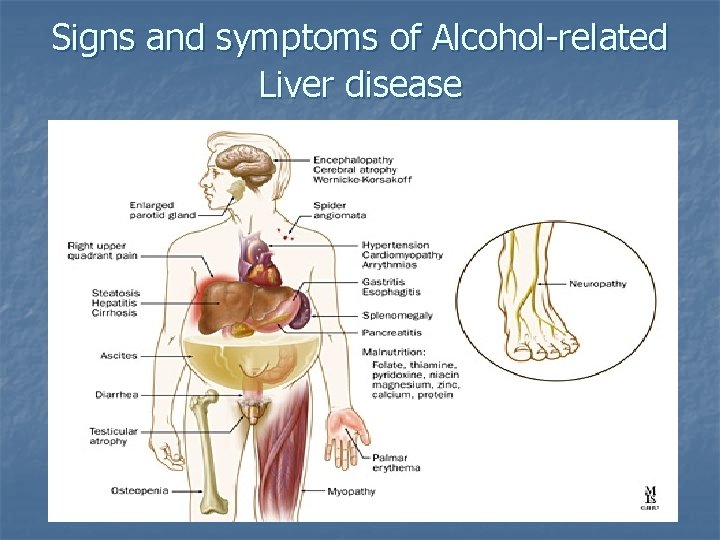 Signs and symptoms of Alcohol-related Liver disease 