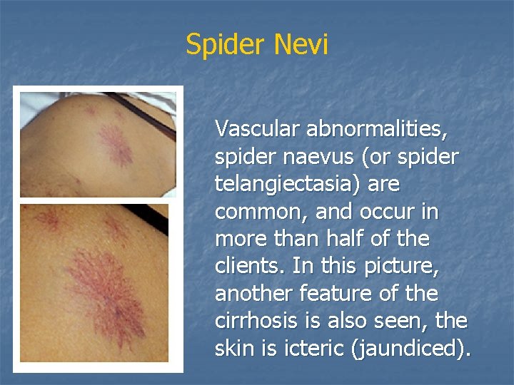 Spider Nevi Vascular abnormalities, spider naevus (or spider telangiectasia) are common, and occur in
