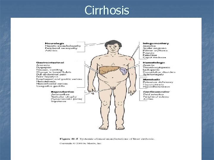 Cirrhosis 