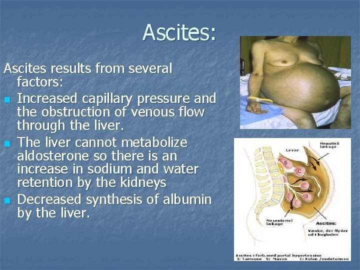 Ascites: Ascites results from several factors: n Increased capillary pressure and the obstruction of