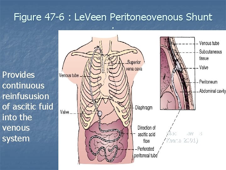 Figure 47 -6 : Le. Veen Peritoneovenous Shunt : Provides continuous reinfususion of ascitic