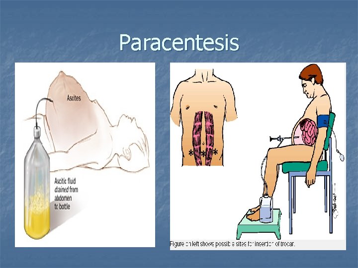 Paracentesis 