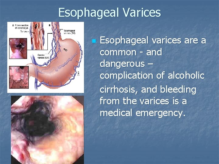 Esophageal Varices n Esophageal varices are a common - and dangerous – complication of