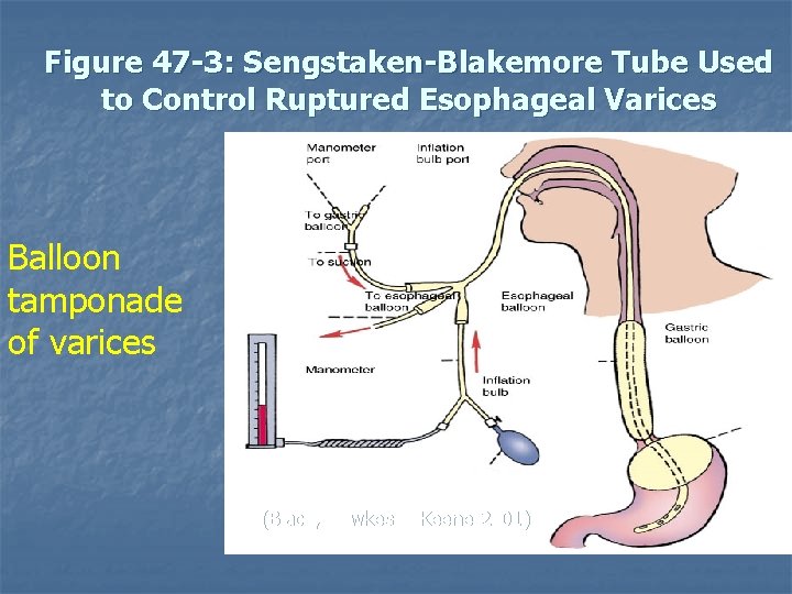 Figure 47 -3: Sengstaken-Blakemore Tube Used to Control Ruptured Esophageal Varices Balloon tamponade of