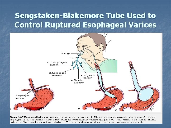 Sengstaken-Blakemore Tube Used to Control Ruptured Esophageal Varices 