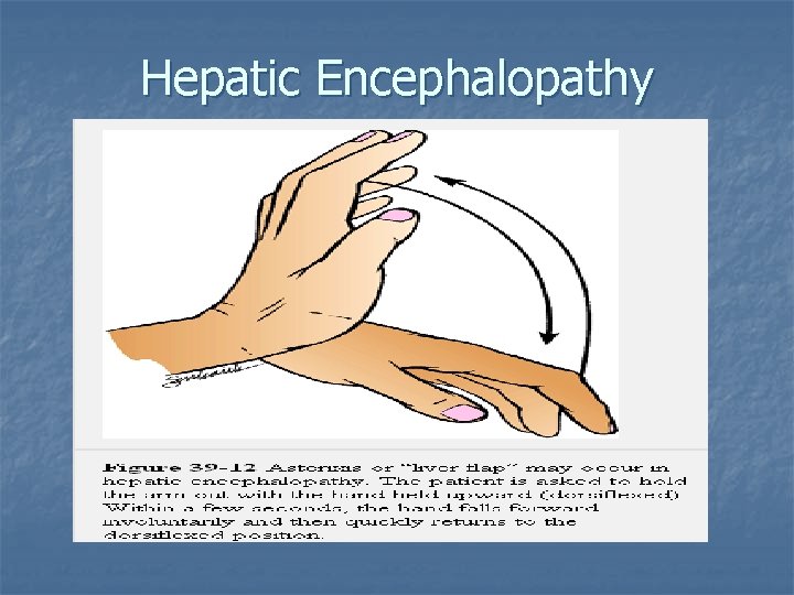 Hepatic Encephalopathy 