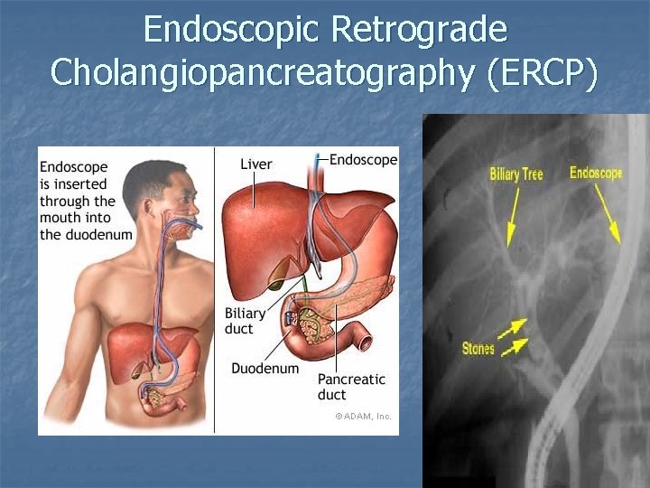 Endoscopic Retrograde Cholangiopancreatography (ERCP) 