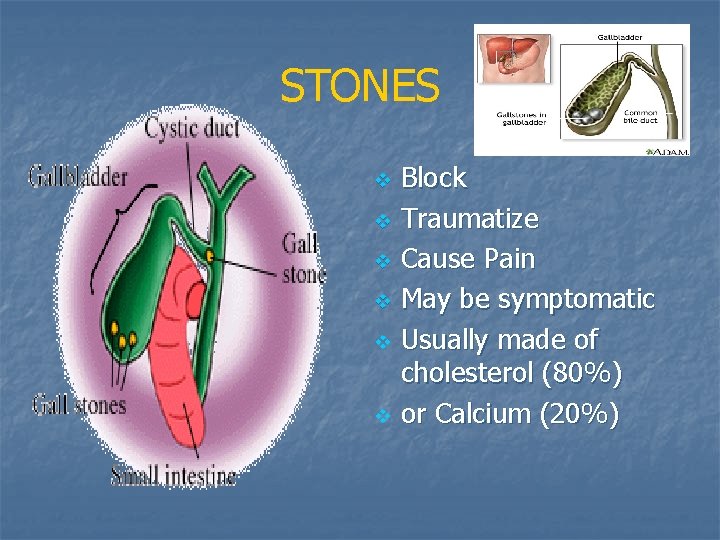 STONES v v v Block Traumatize Cause Pain May be symptomatic Usually made of