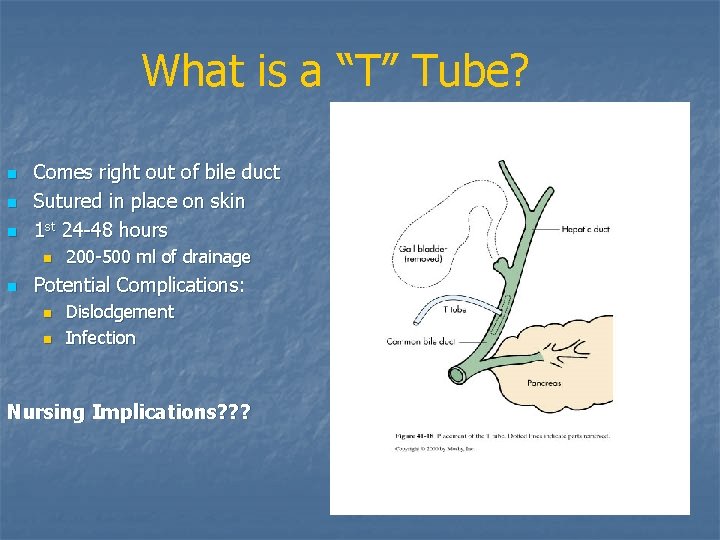What is a “T” Tube? n n n Comes right out of bile duct