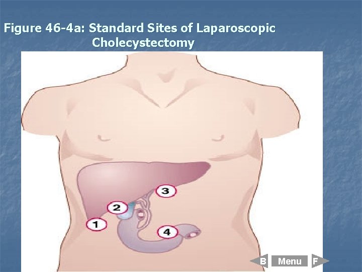 Figure 46 -4 a: Standard Sites of Laparoscopic Cholecystectomy B Menu F 