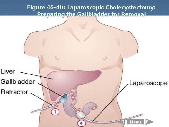 Figure 46 -4 b: Laparoscopic Cholecystectomy: Preparing the Gallbladder for Removal B Menu F