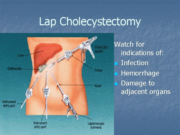 Lap Cholecystectomy Watch for indications of: n Infection n Hemorrhage n Damage to adjacent