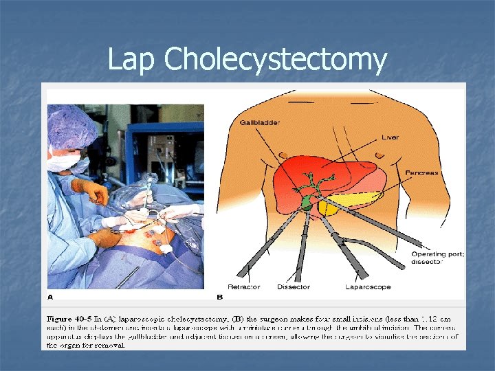 Lap Cholecystectomy 