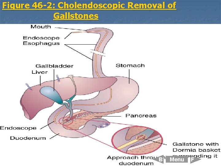 Figure 46 -2: Cholendoscopic Removal of Gallstones B Menu F 