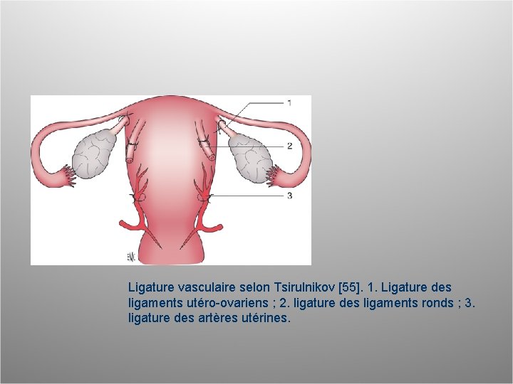 Ligature vasculaire selon Tsirulnikov [55]. 1. Ligature des ligaments utéro-ovariens ; 2. ligature des