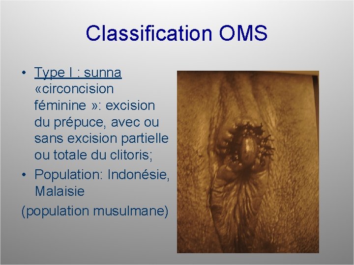 Classification OMS • Type I : sunna «circoncision féminine » : excision du prépuce,