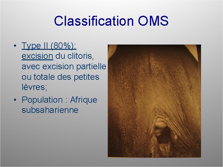 Classification OMS • Type II (80%): excision du clitoris, avec excision partielle ou totale