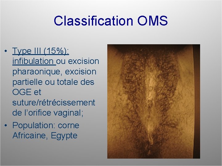 Classification OMS • Type III (15%): infibulation ou excision pharaonique, excision partielle ou totale